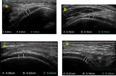 ultrasound validity in the measurement of knee cartilage thickness|Evaluation of knee cartilage thickness: A comparison .